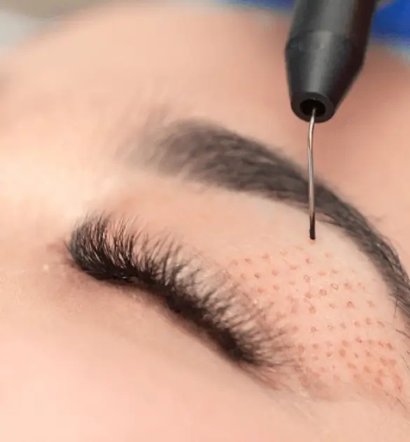 Plasma Pen Treatment