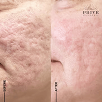 ACNE SCAR REJUVENATION