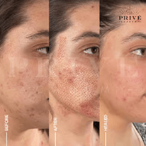 ACNE SCAR REJUVENATION
