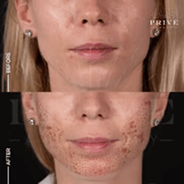 ACNE SCAR REJUVENATION Slider Image 4