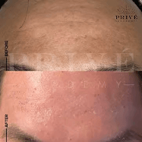 FOREHEAD AREA