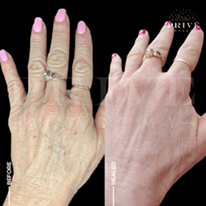 HANDS TIGHTENING REJUVENATION