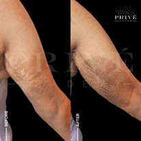 HANDS TIGHTENING REJUVENATION