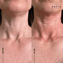 NECK AREA